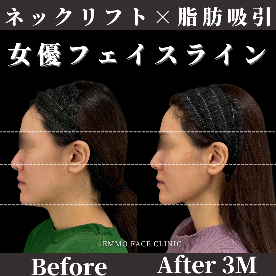 ネックリフト×アゴ下脂肪吸引