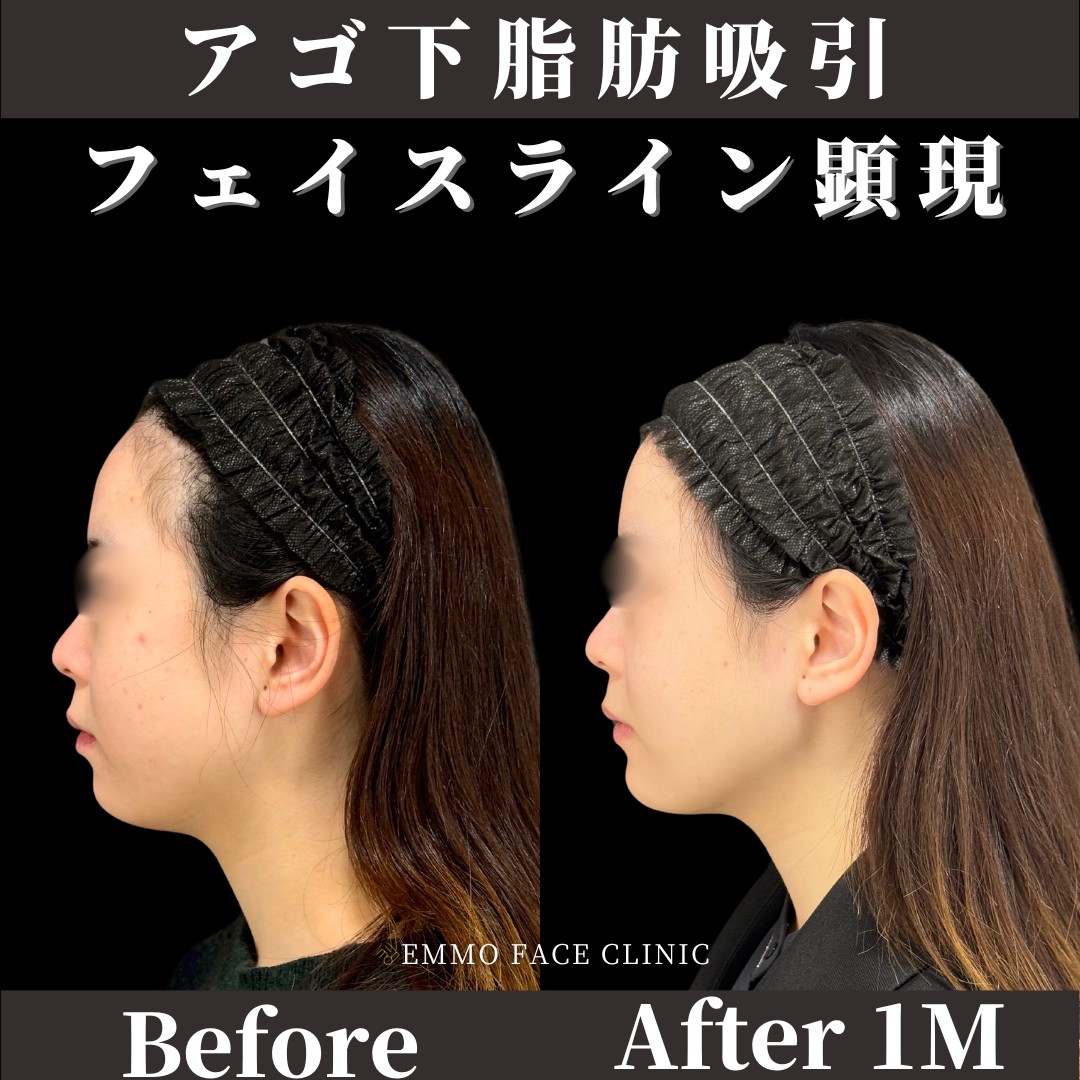 アゴ下脂肪吸引 フェイスライン顕現