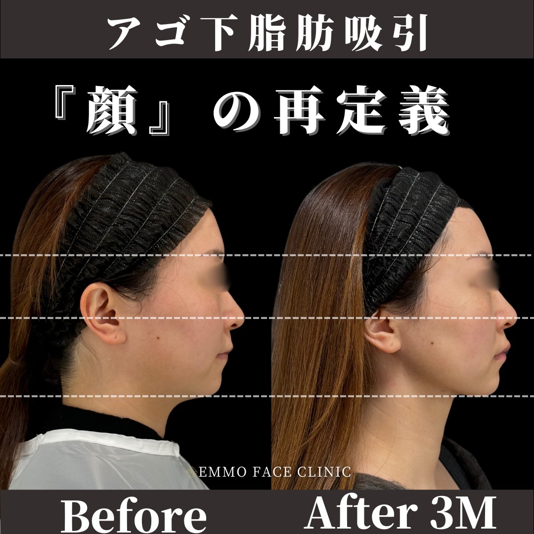 アゴ下 脂肪吸引