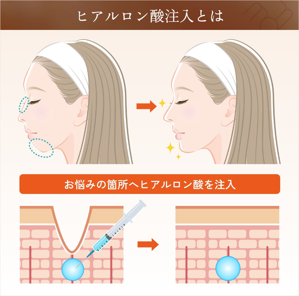 ヒアルロン酸注射