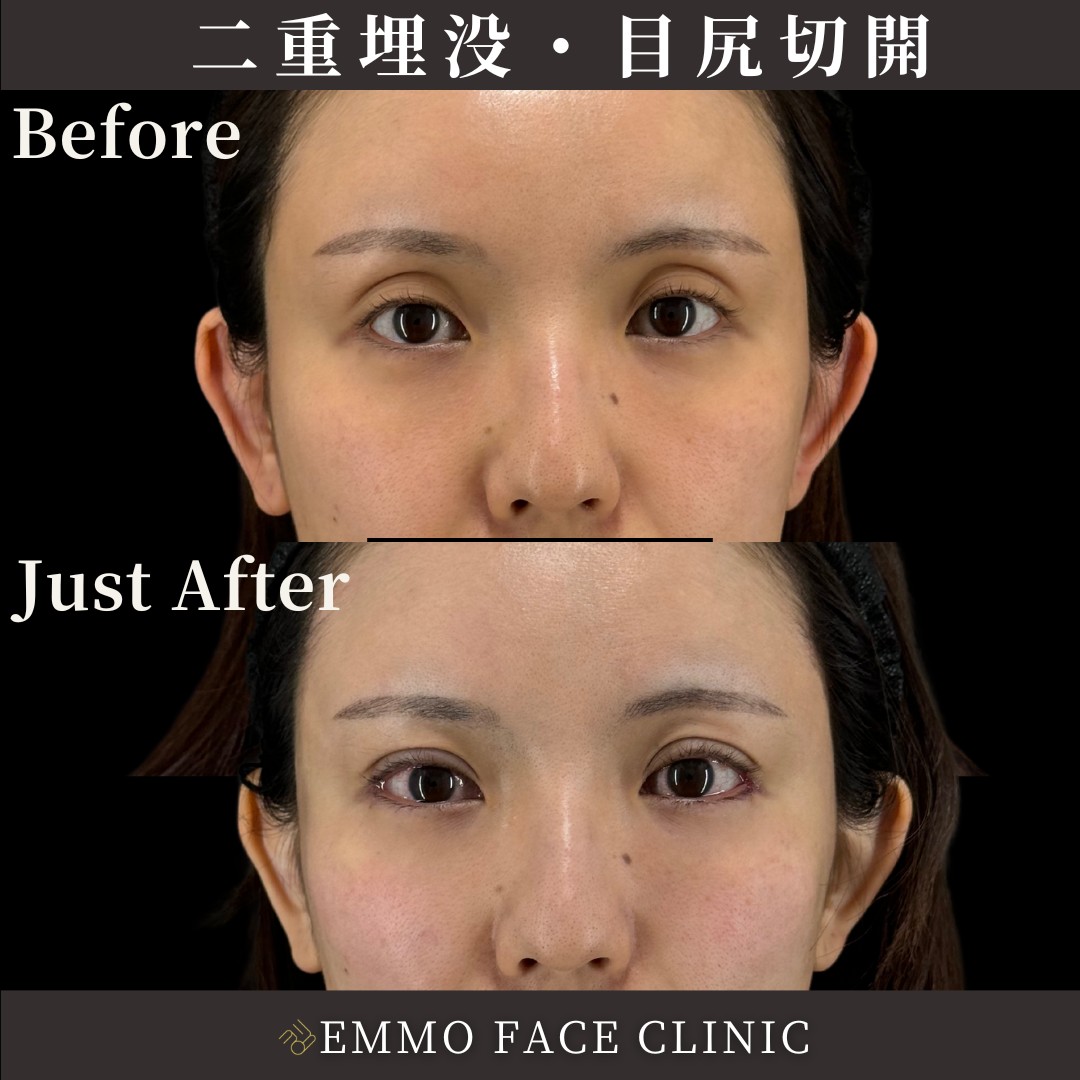 二重埋没×目尻切開