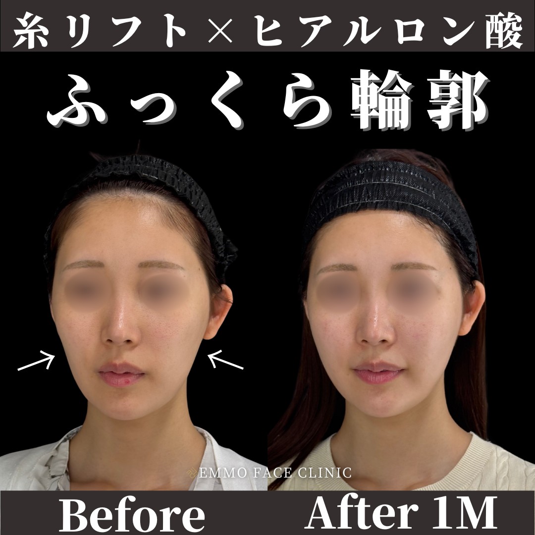 糸リフト×ヒアルロン酸