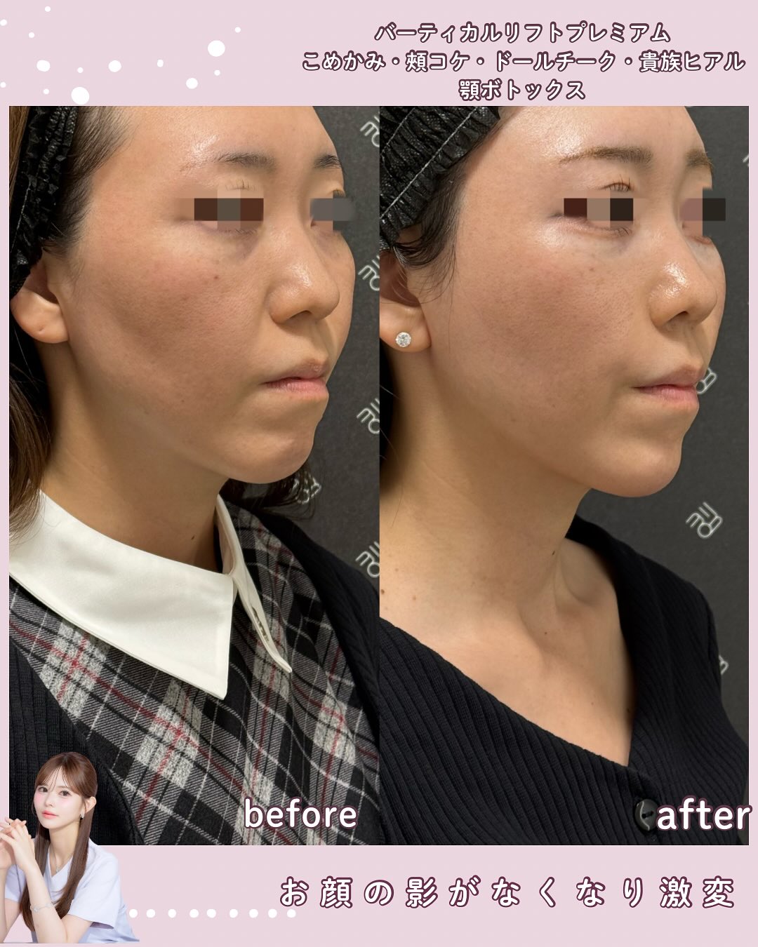 バーティカルリフトプレミアム