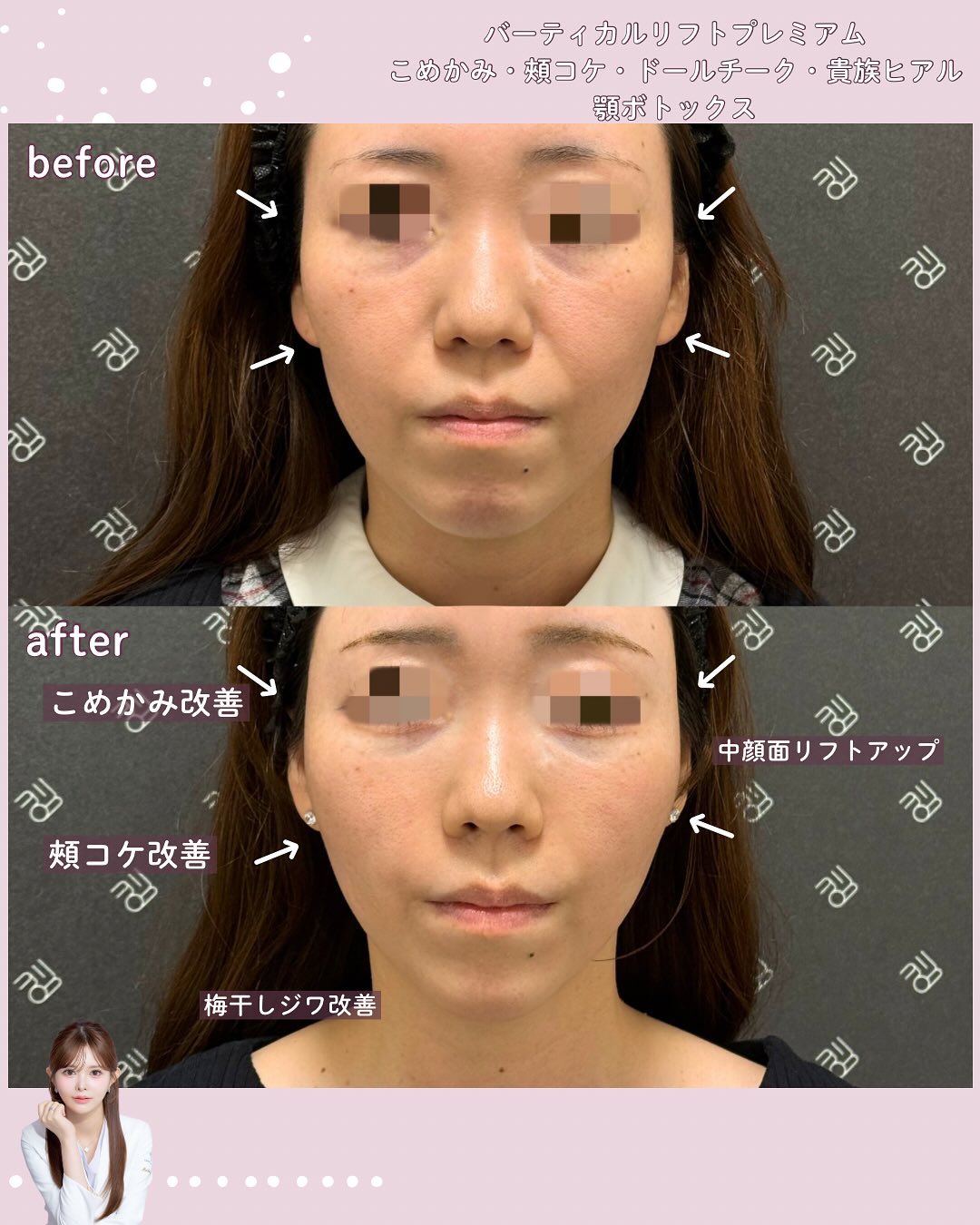 バーティカルリフトプレミアム