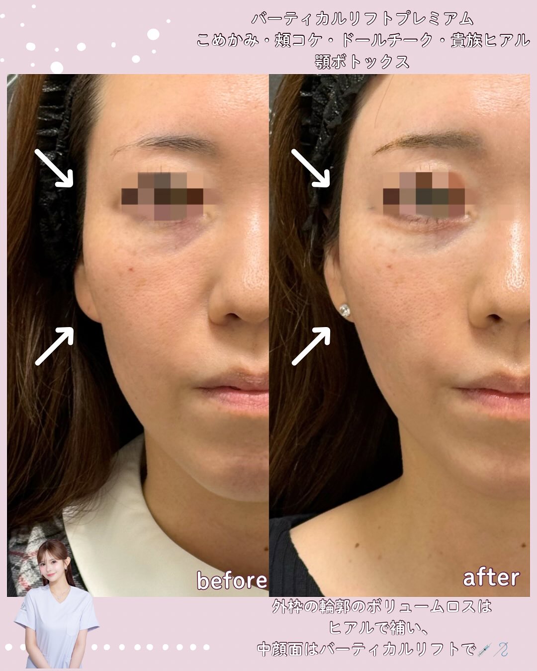 バーティカルリフトプレミアム