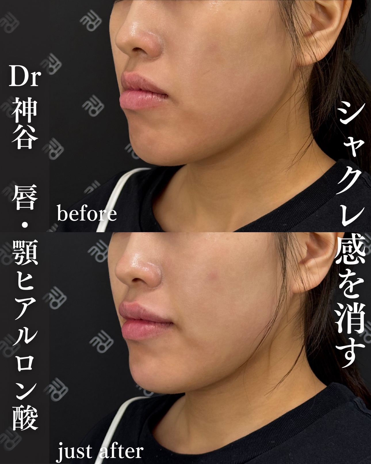 ヒアルロン酸ー症例写真