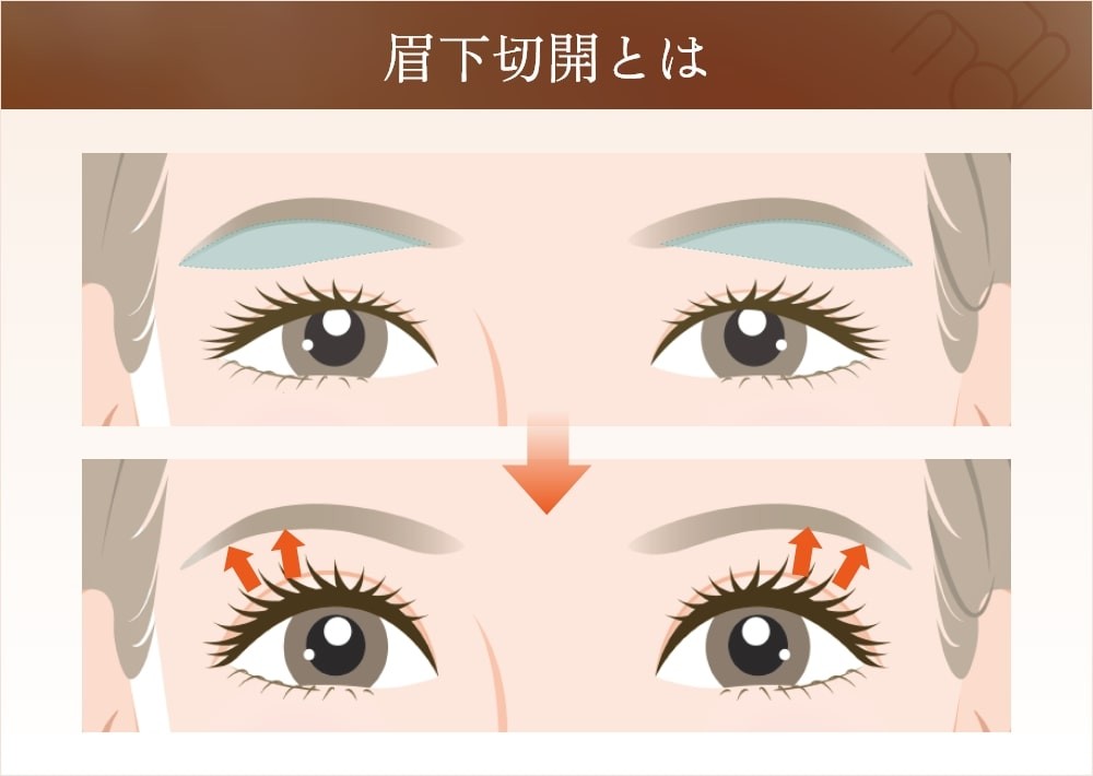 眉下切開