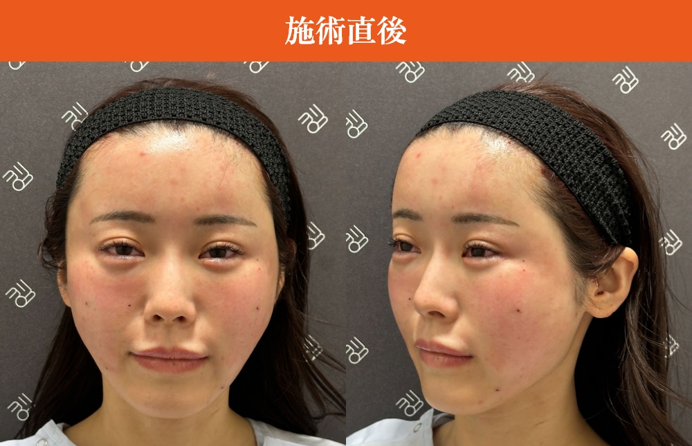 施術直後