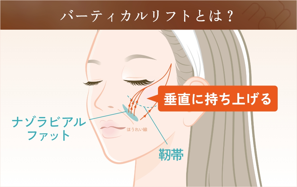 バーティカルリフト