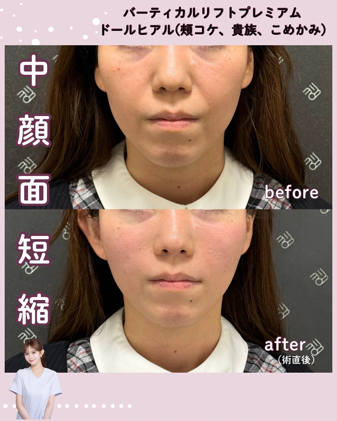 バーティカルリフト×ドールヒアル