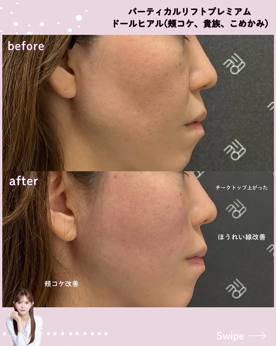 バーティカルリフト×ドールヒアル