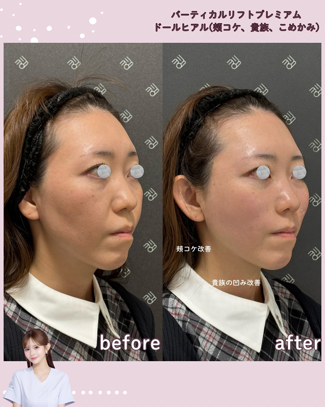 バーティカルリフト×ドールヒアル