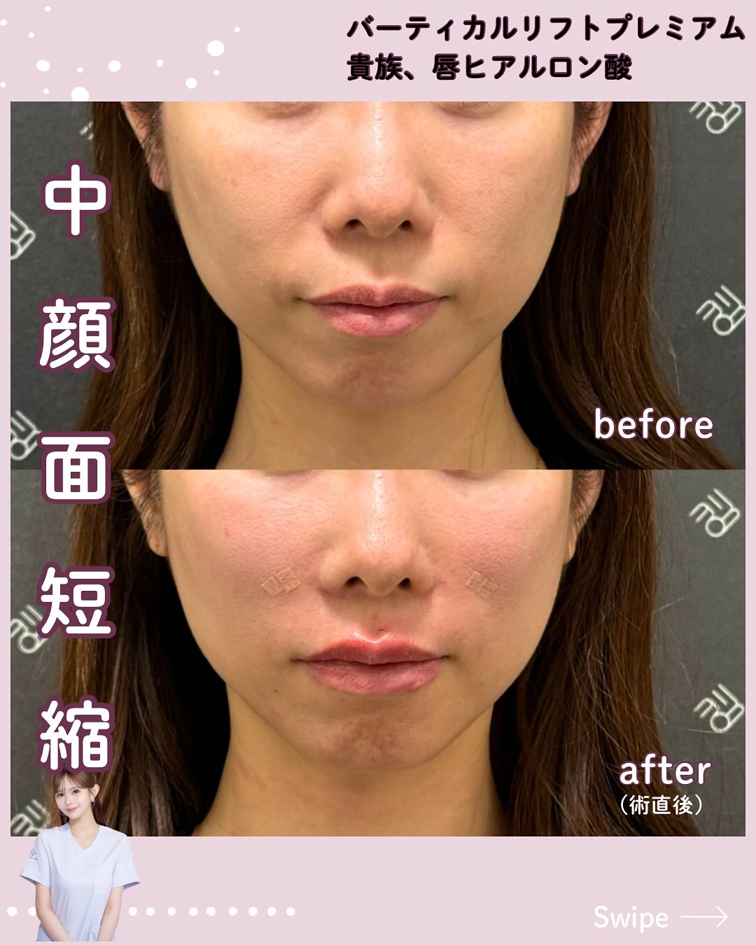 バーティカルリフト×ヒアルロン酸
