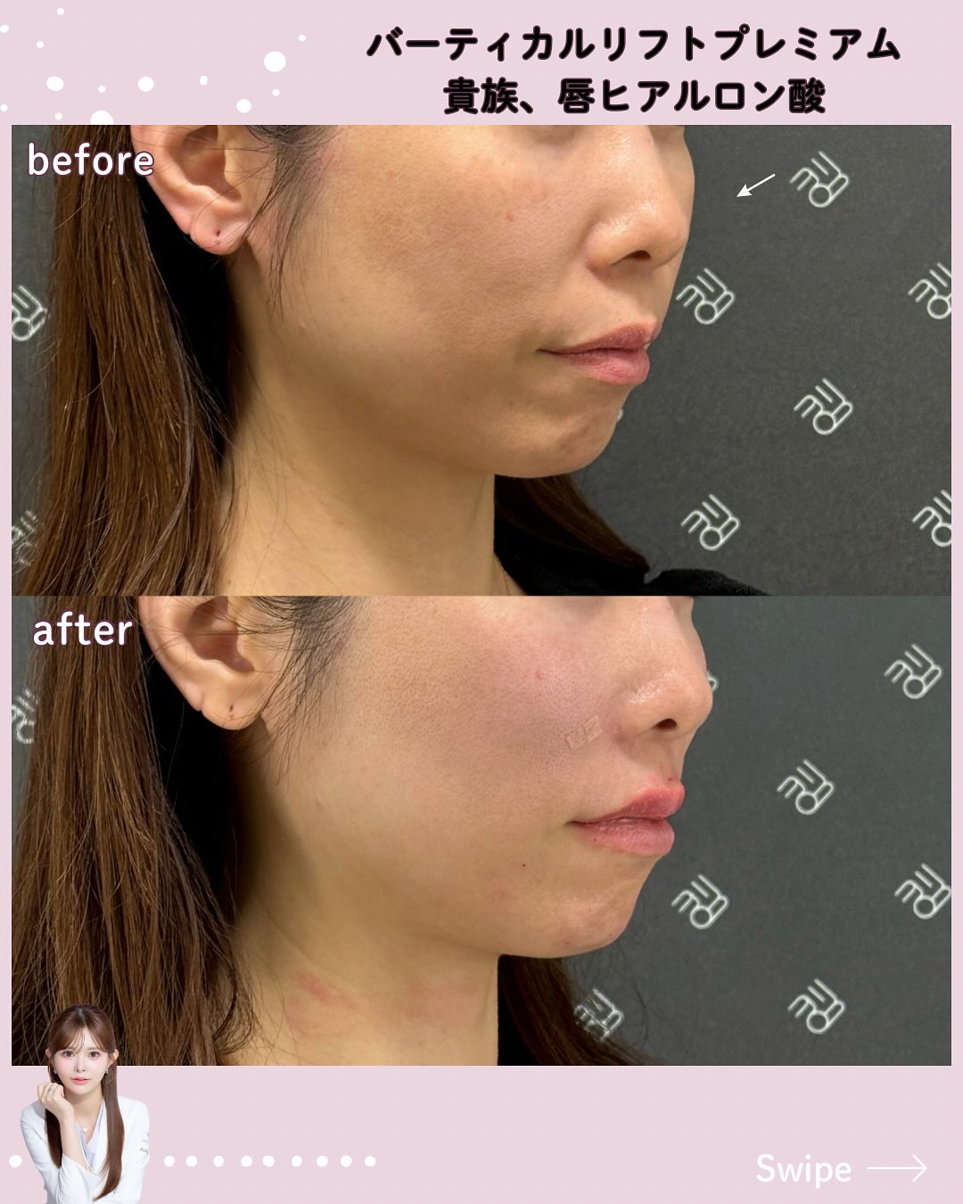 バーティカルリフト×ヒアルロン酸