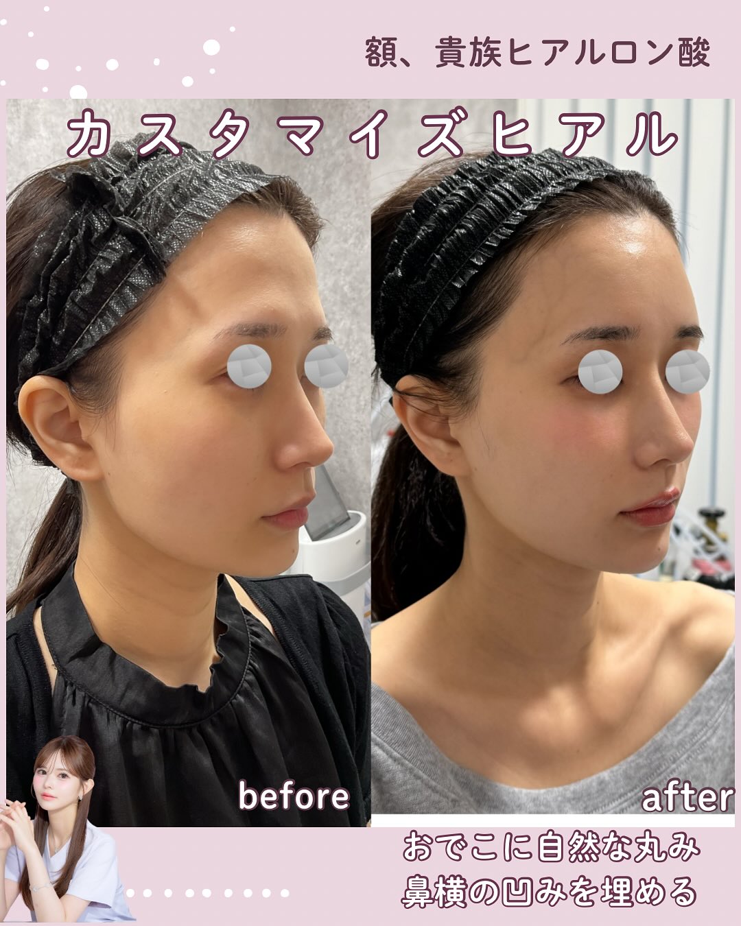 カスタマイズヒアル