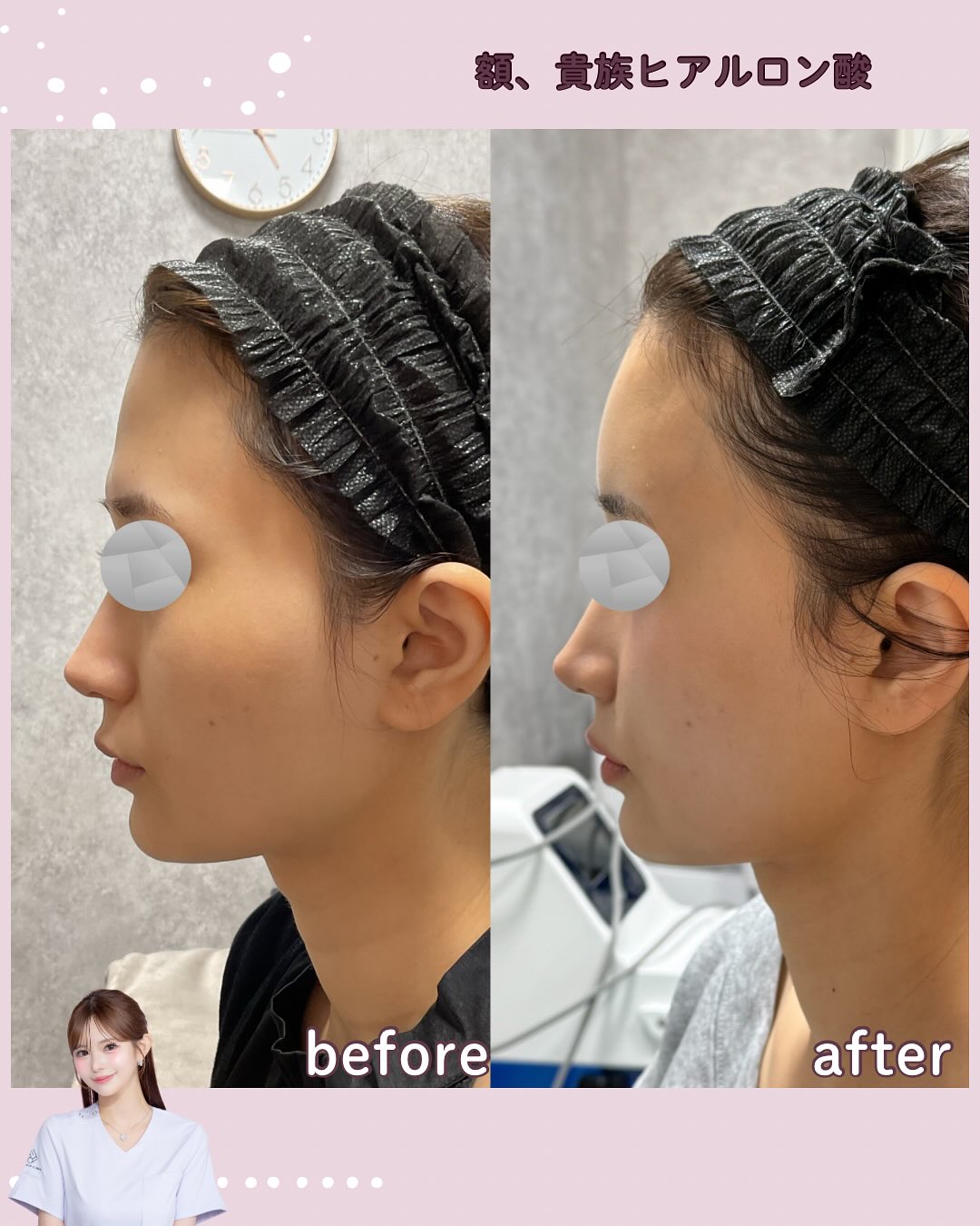 カスタマイズヒアル