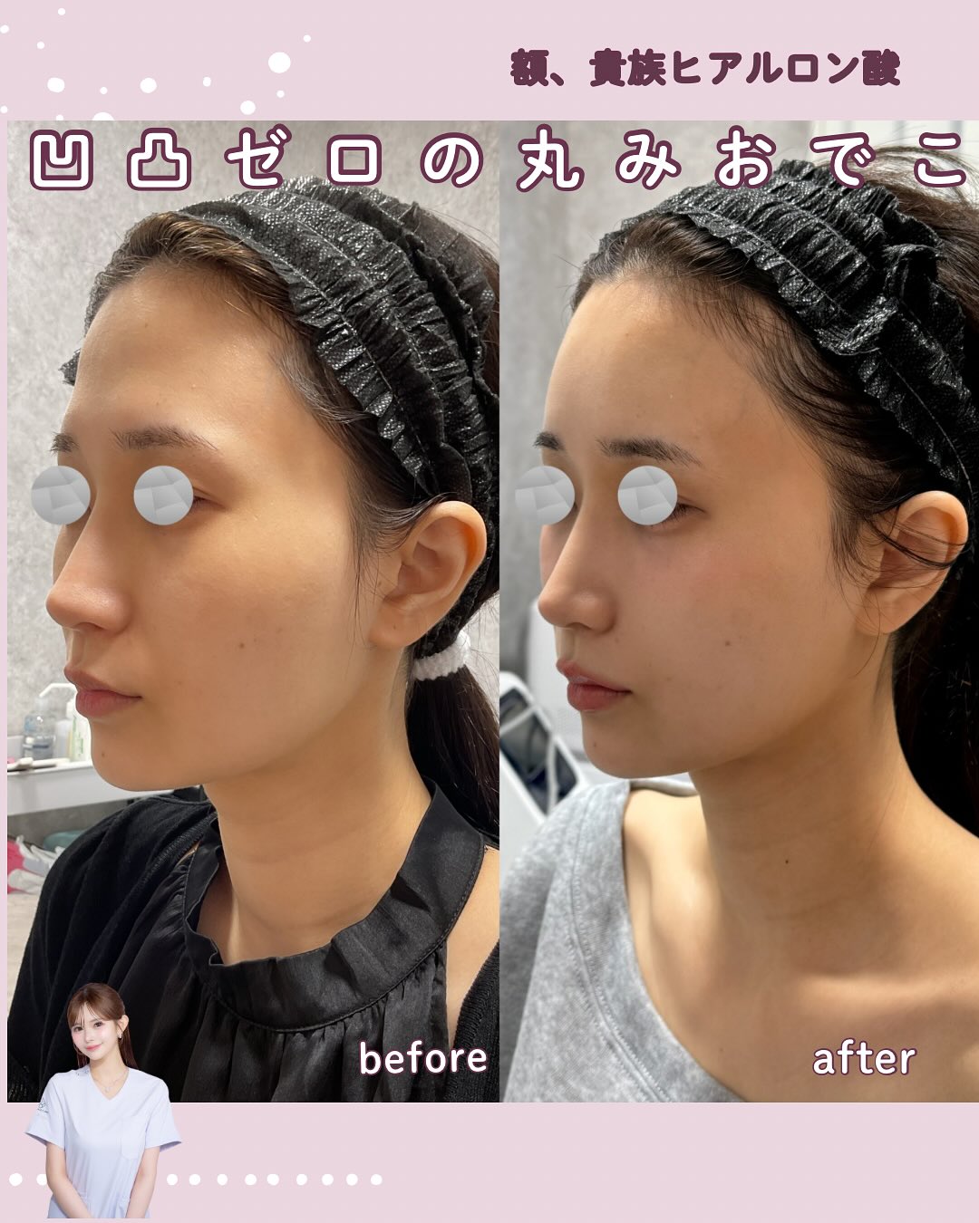 カスタマイズヒアル