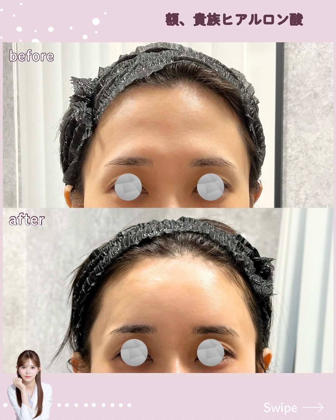 カスタマイズヒアル