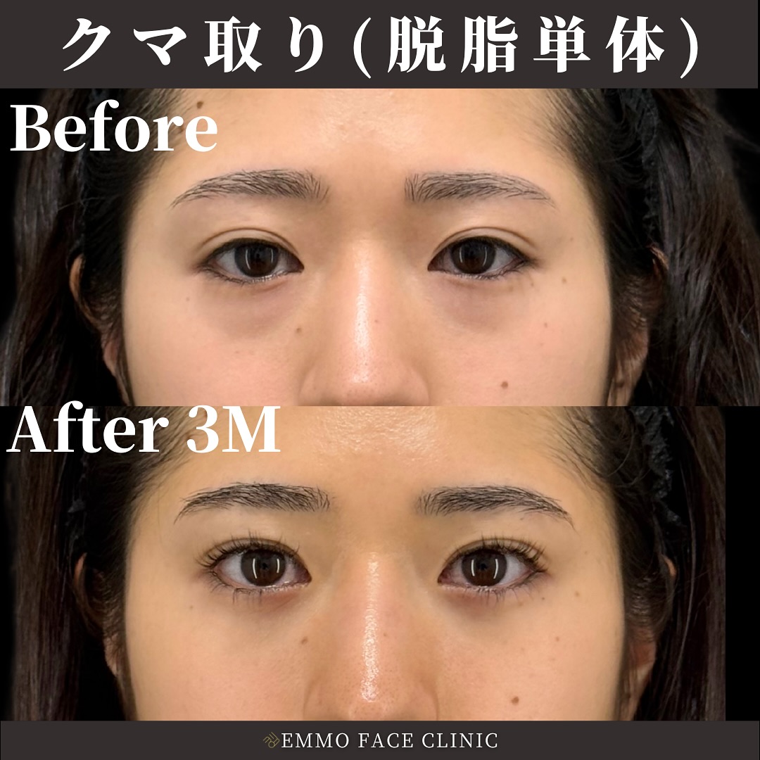 クマ取り(脱脂単体)