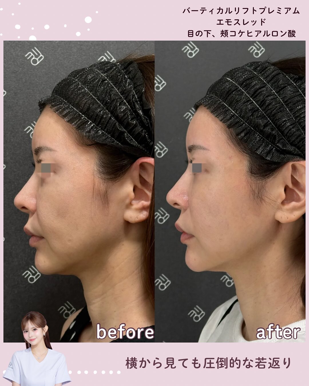 バーティカル×糸リフト×ヒアルロン酸