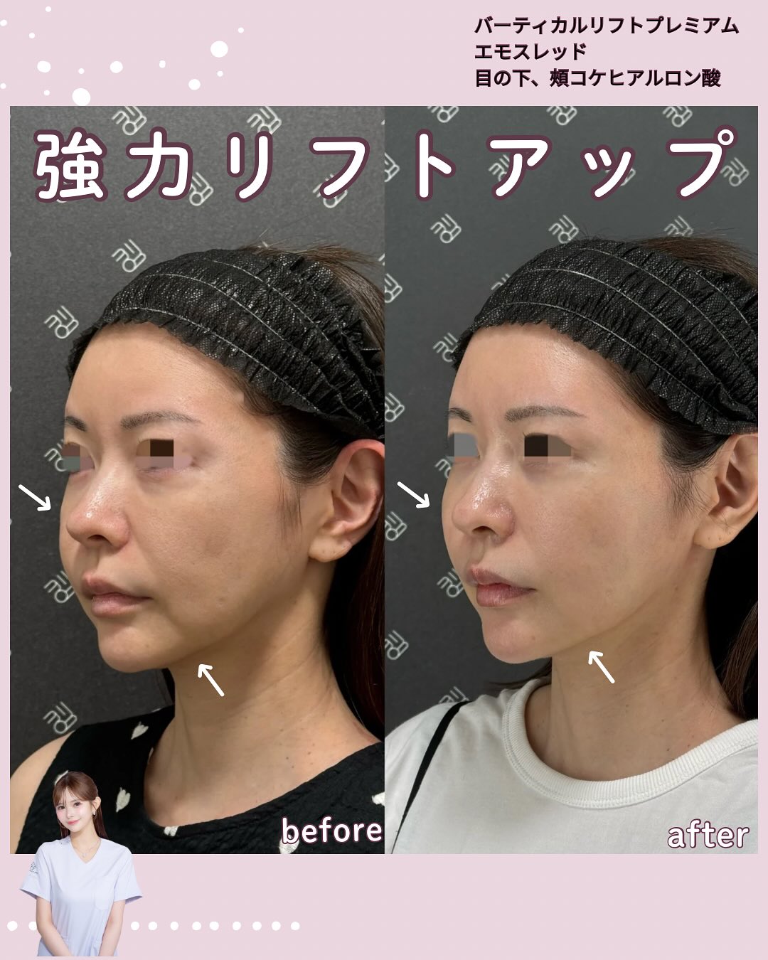 バーティカル×糸リフト×ヒアルロン酸