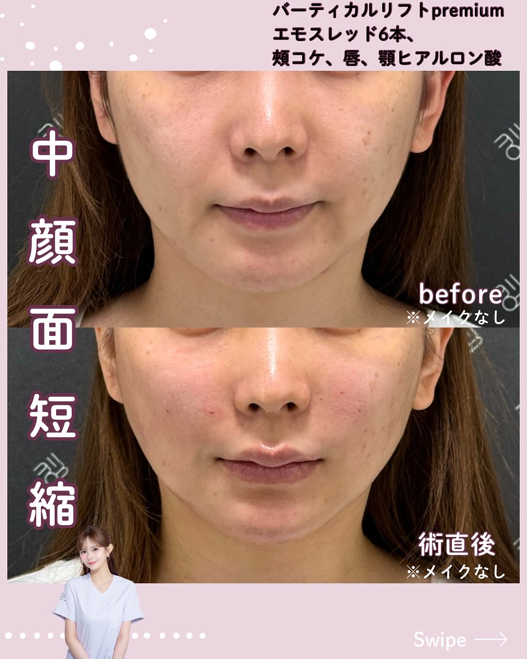 バーティカルリフトプレミアム×エモスレッド×ヒアルロン酸