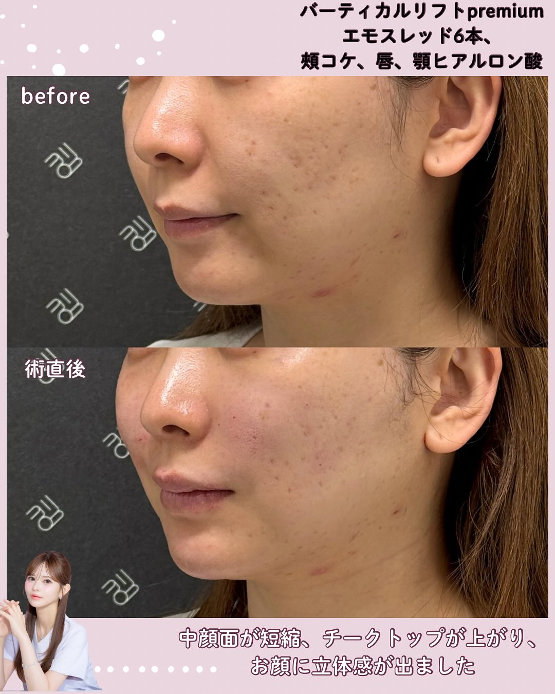 バーティカルリフトプレミアム×エモスレッド×ヒアルロン酸