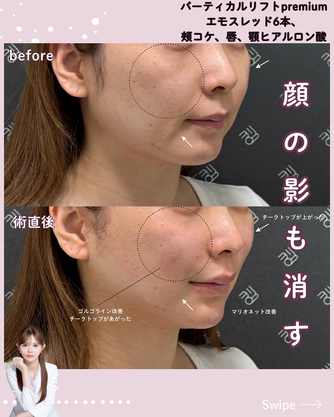 バーティカルリフトプレミアム×エモスレッド×ヒアルロン酸