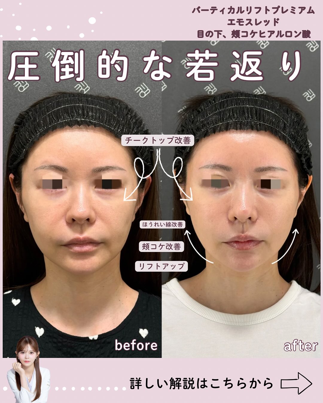 バーティカル×糸リフト×ヒアルロン酸