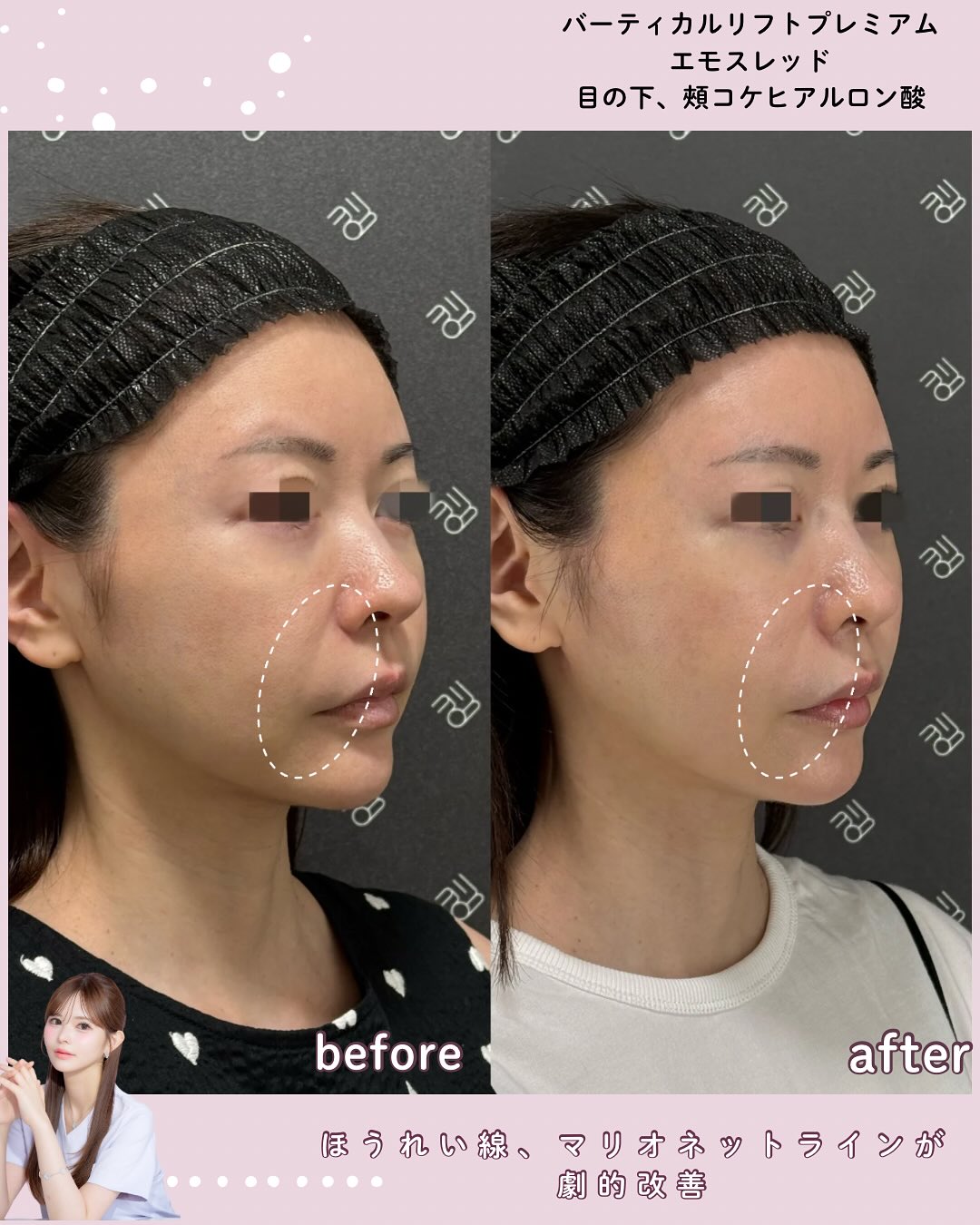 バーティカル×糸リフト×ヒアルロン酸