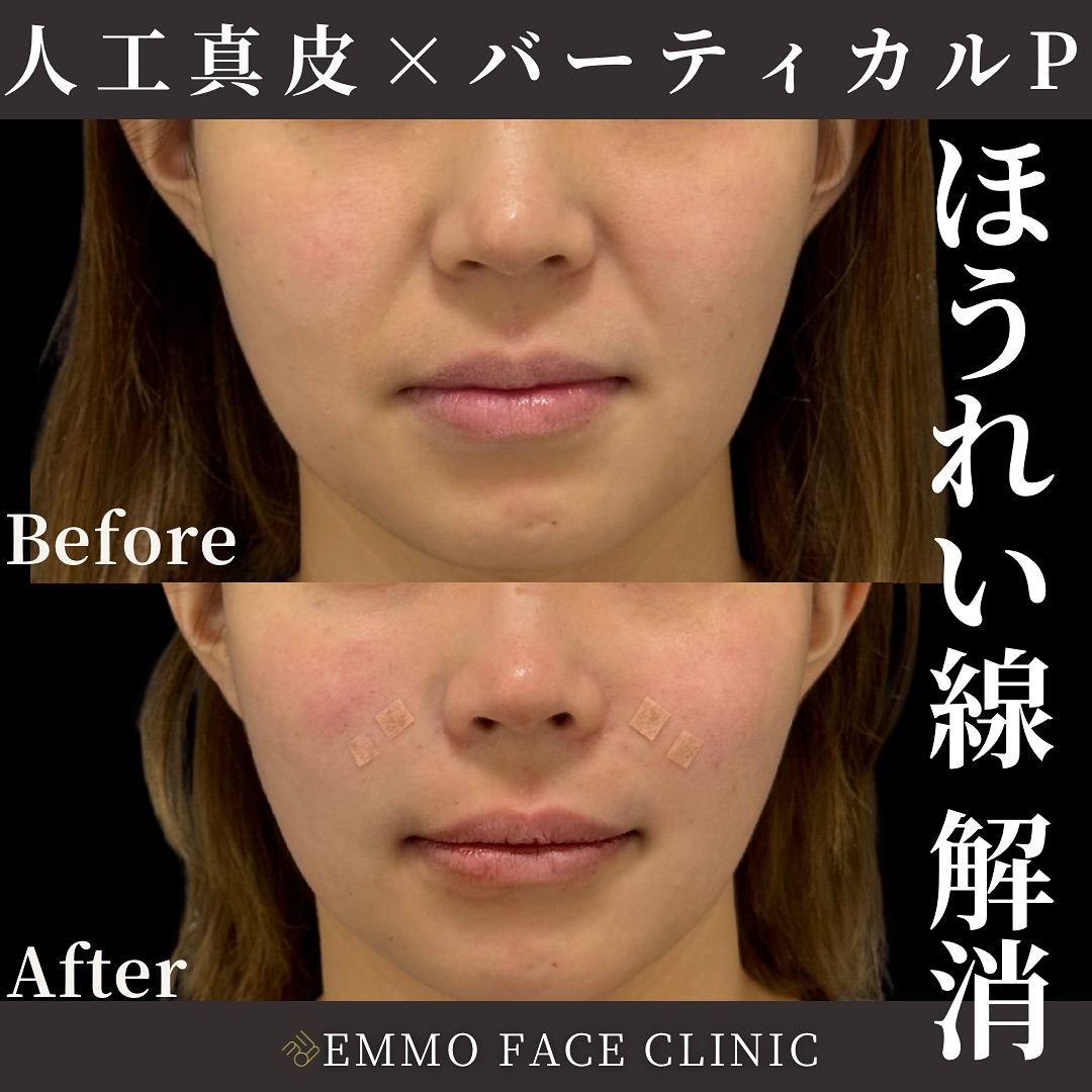 人工真皮×バーティカルリフトプレミアム