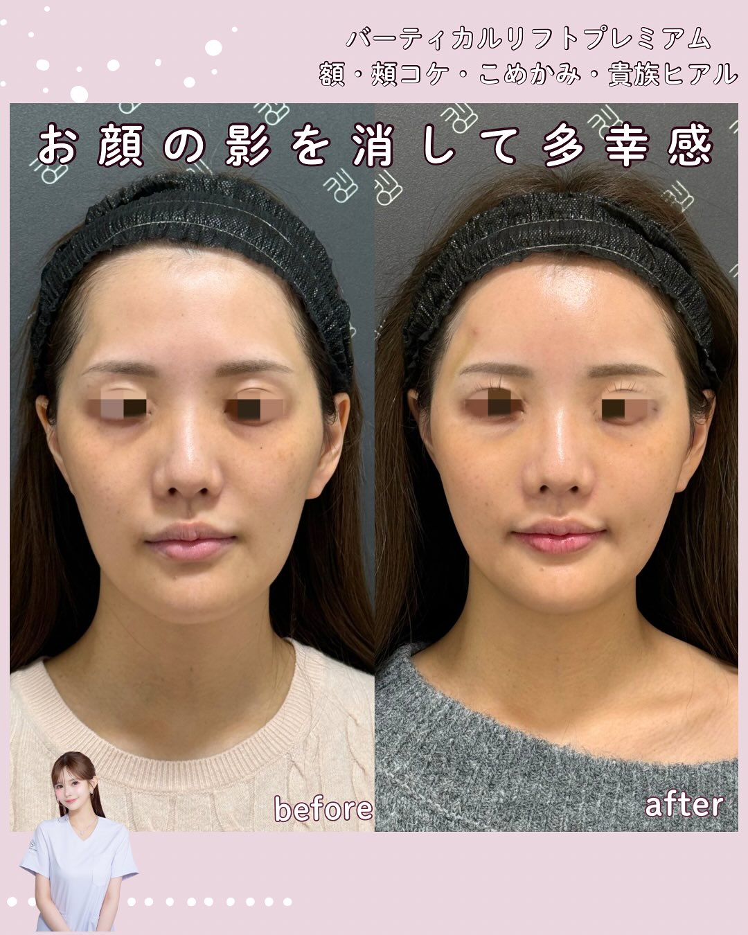 バーティカルリフトプレミアム