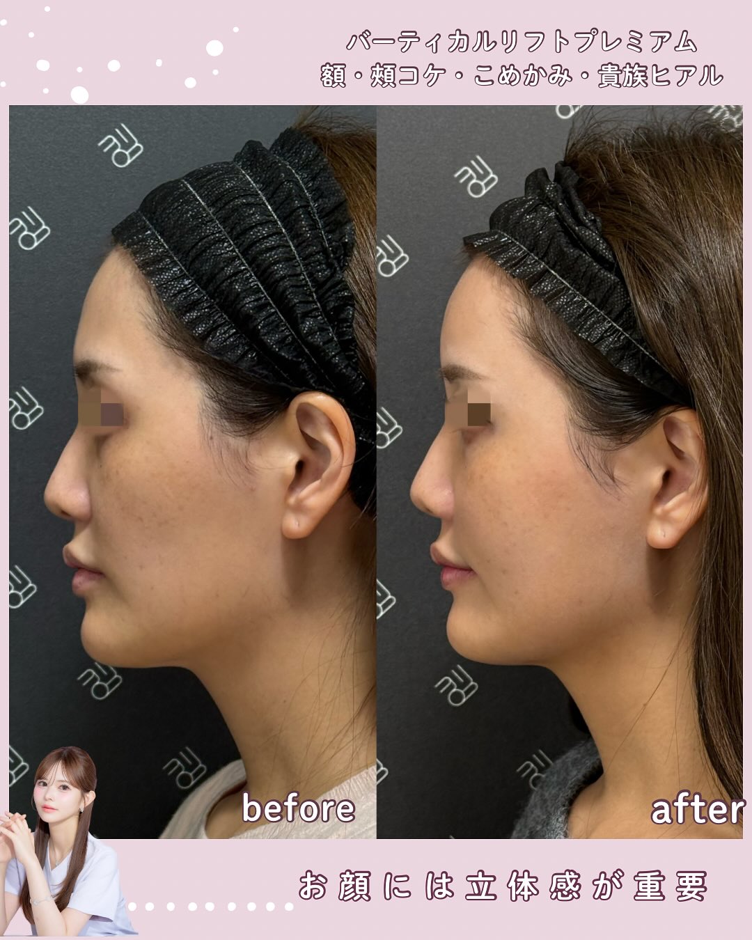 バーティカルリフトプレミアム