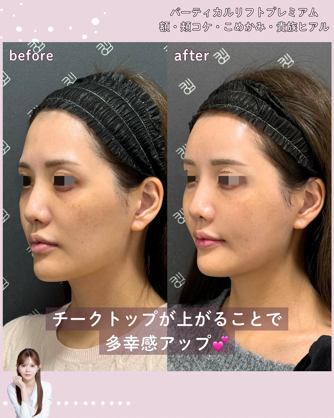 バーティカルリフトプレミアム