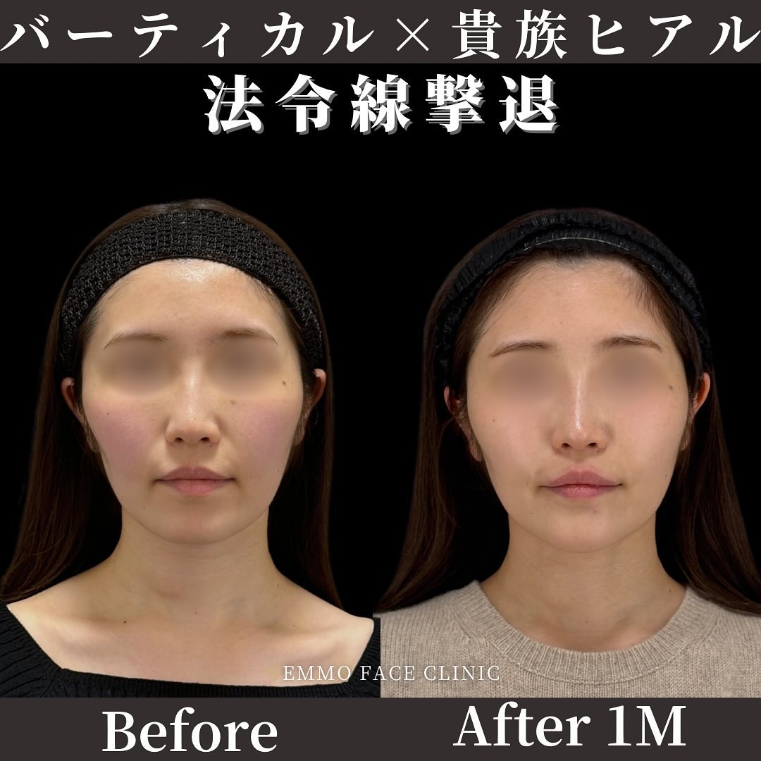 バーティカルリフト 貴族ヒアルロン