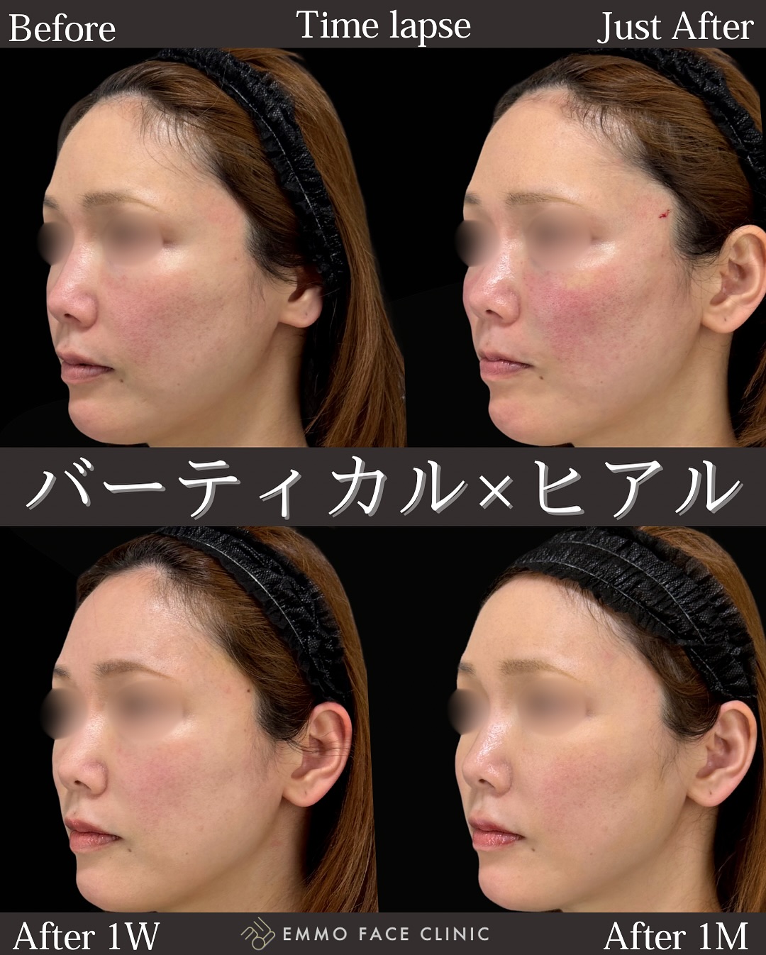 バーティカルリフト×チークトップヒアル