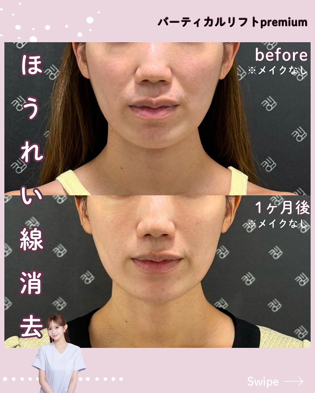 バーティカルリフトプレミアム