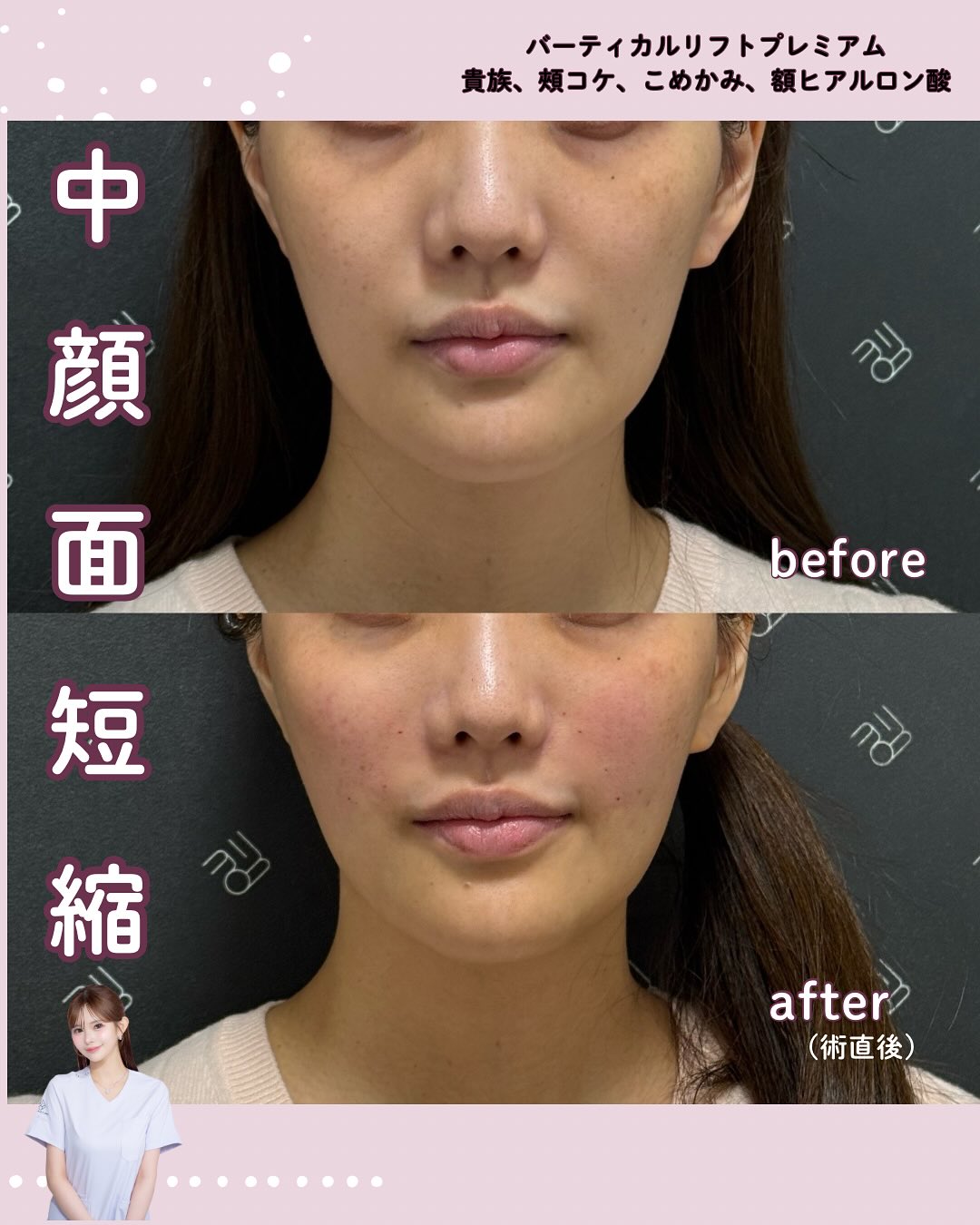 バーティカルリフトプレミアム×ヒアルロン酸