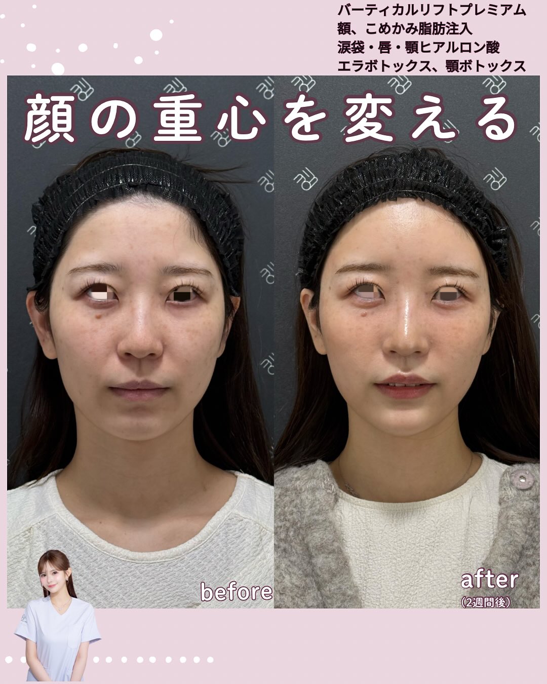 バーティカルリフトプレミアム