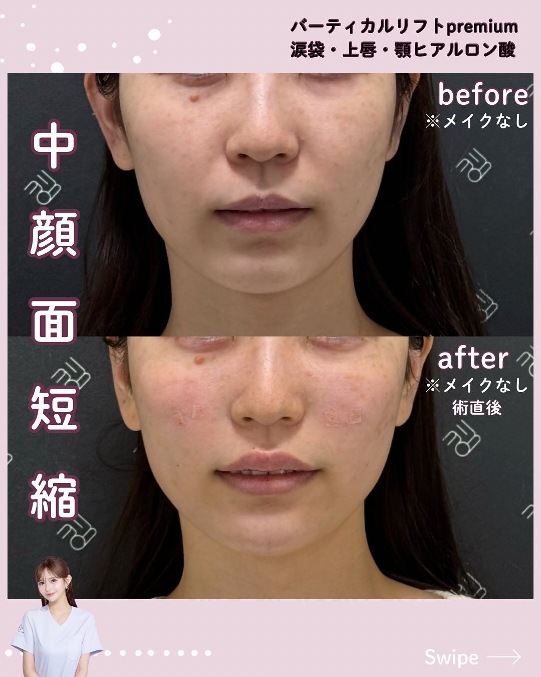 バーティカルリフトプレミアム×ドールヒアル