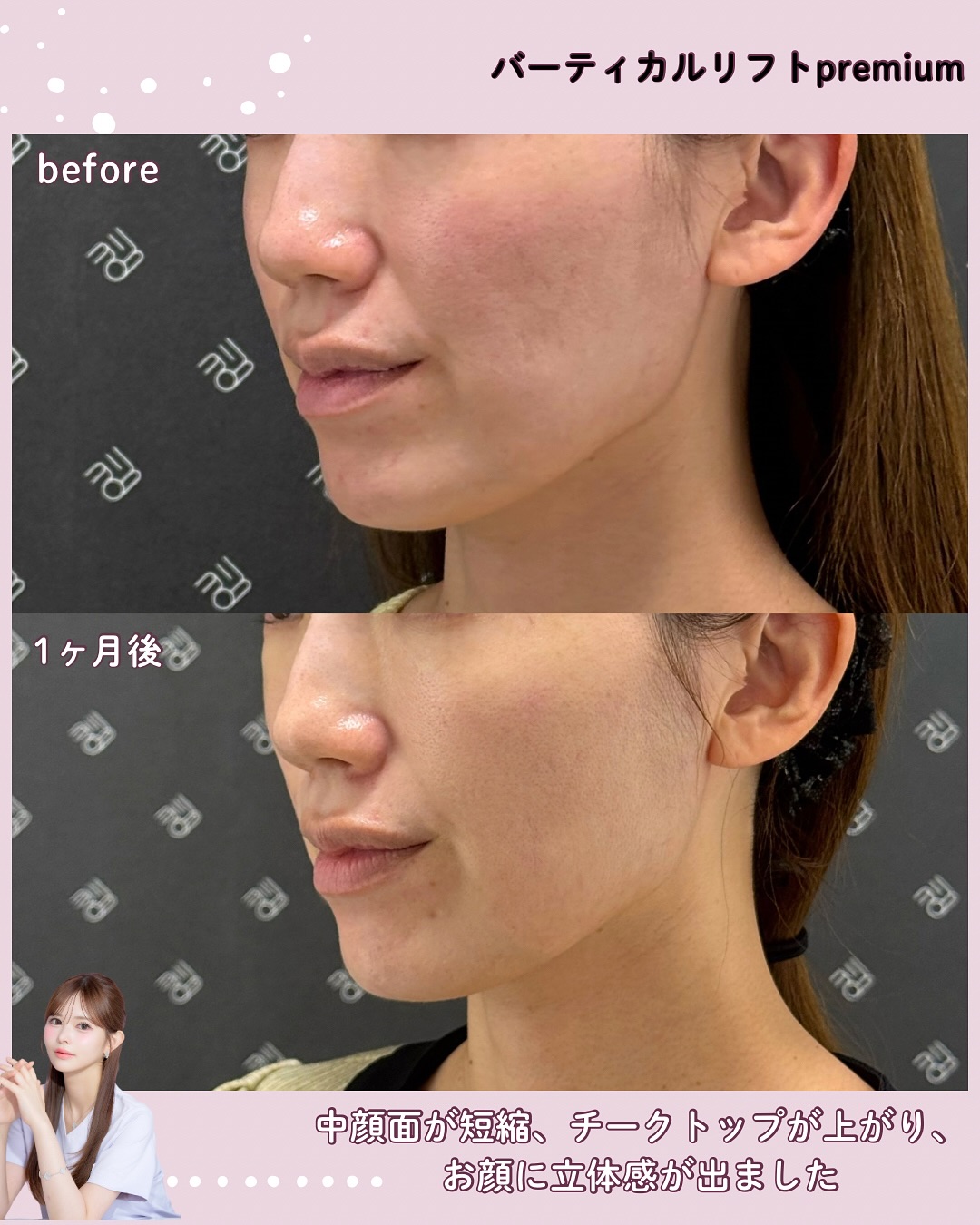 バーティカルリフトプレミアム