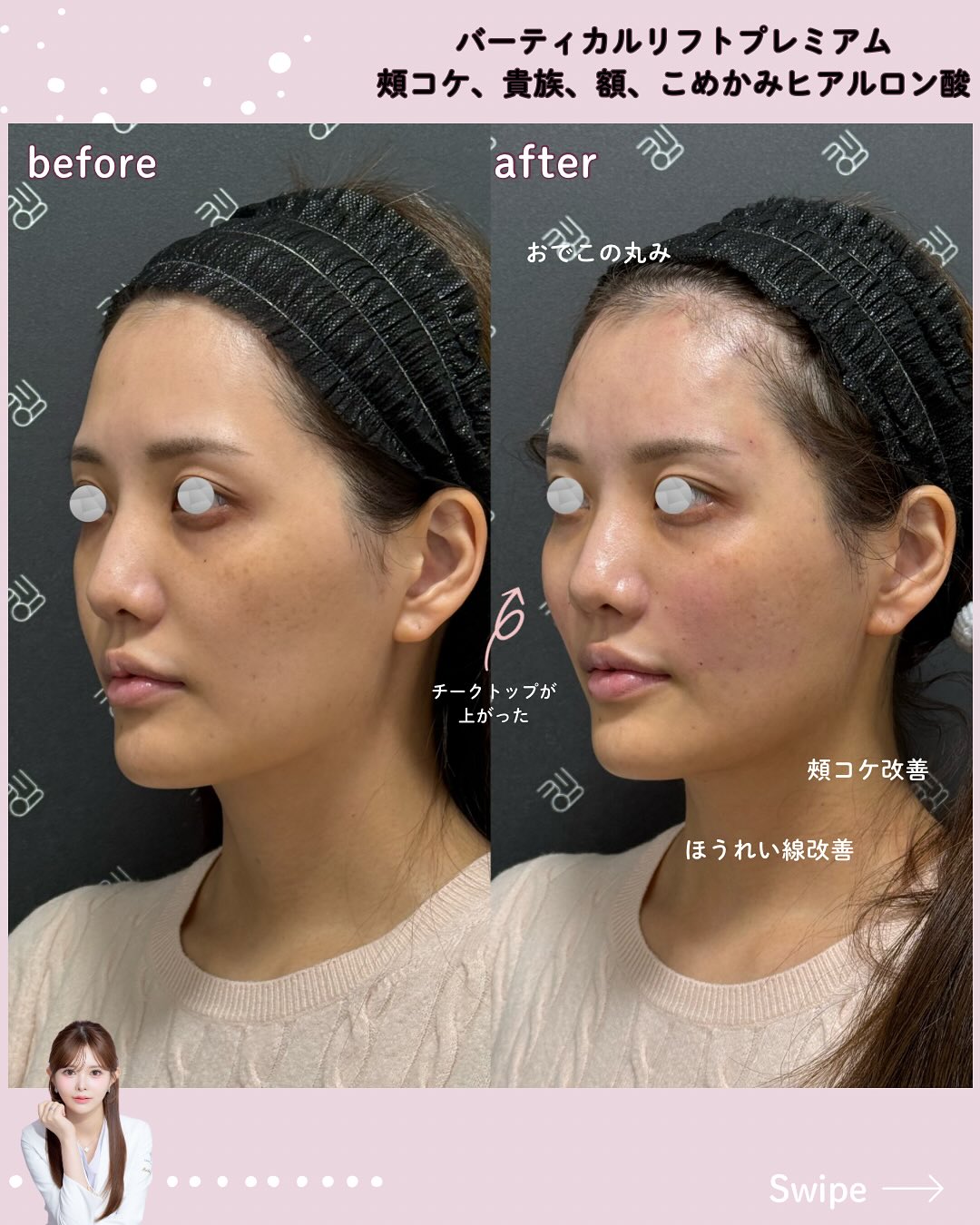 バーティカルリフトプレミアム×ヒアルロン酸