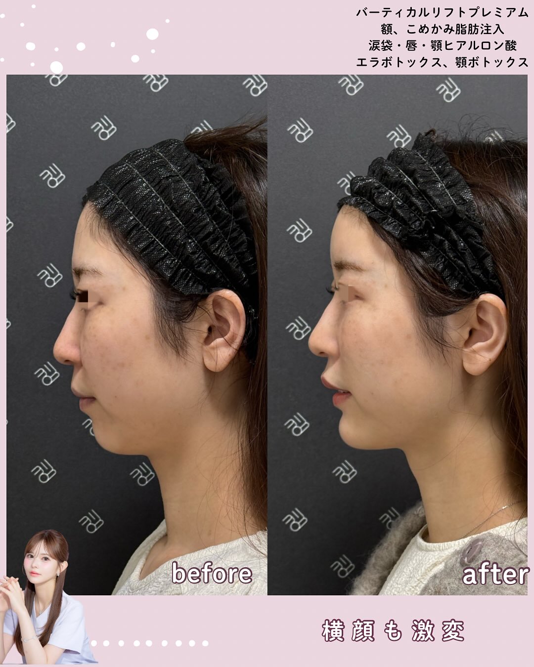 バーティカルリフトプレミアム