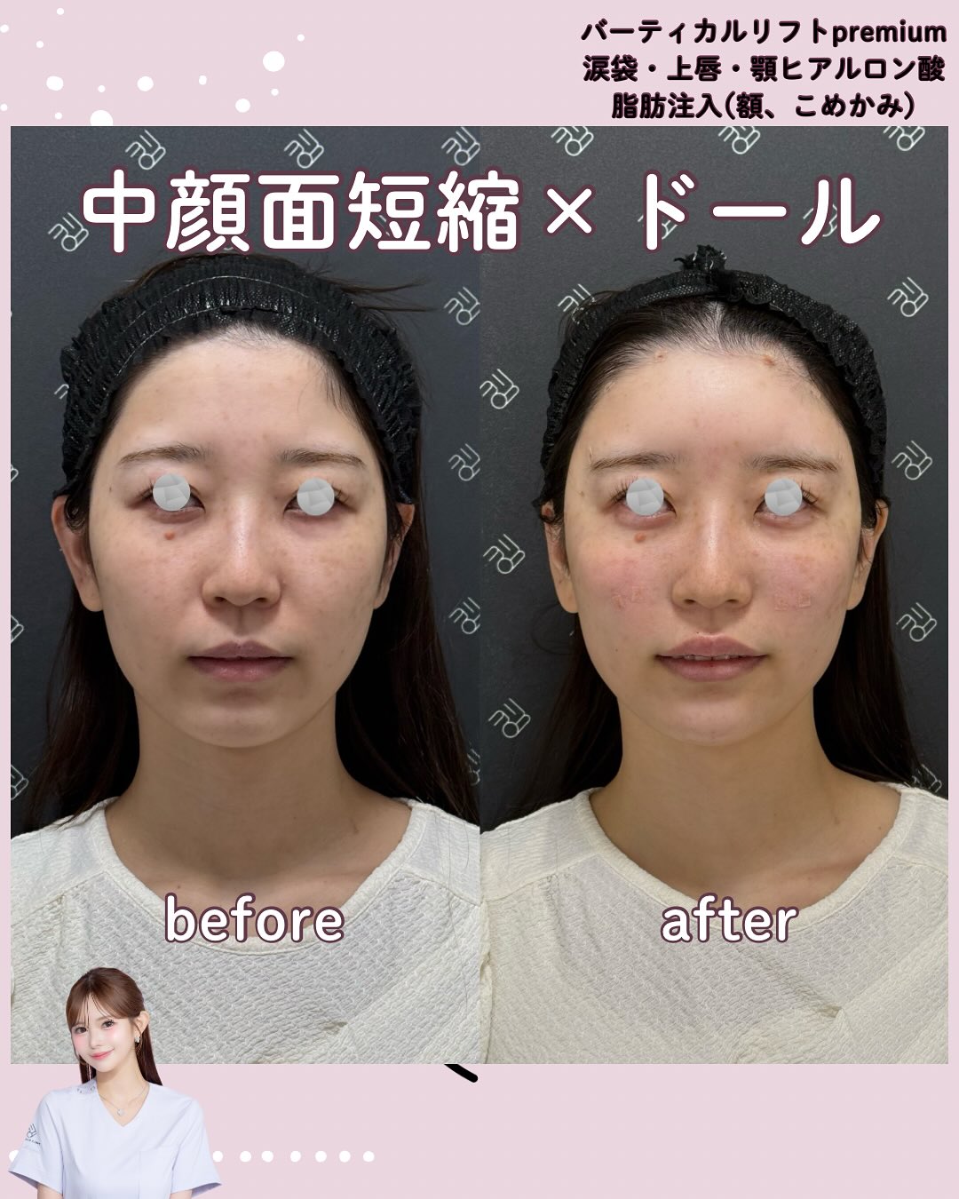 バーティカルリフトプレミアム×ドールヒアル