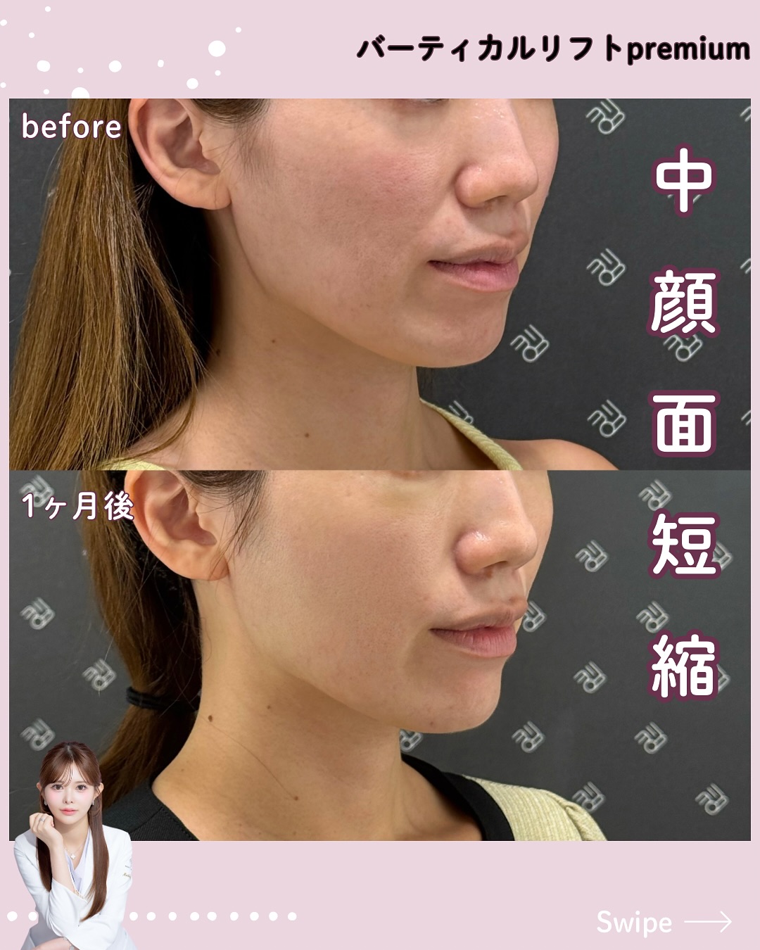 バーティカルリフトプレミアム