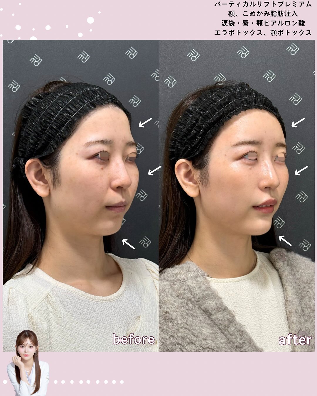 バーティカルリフトプレミアム