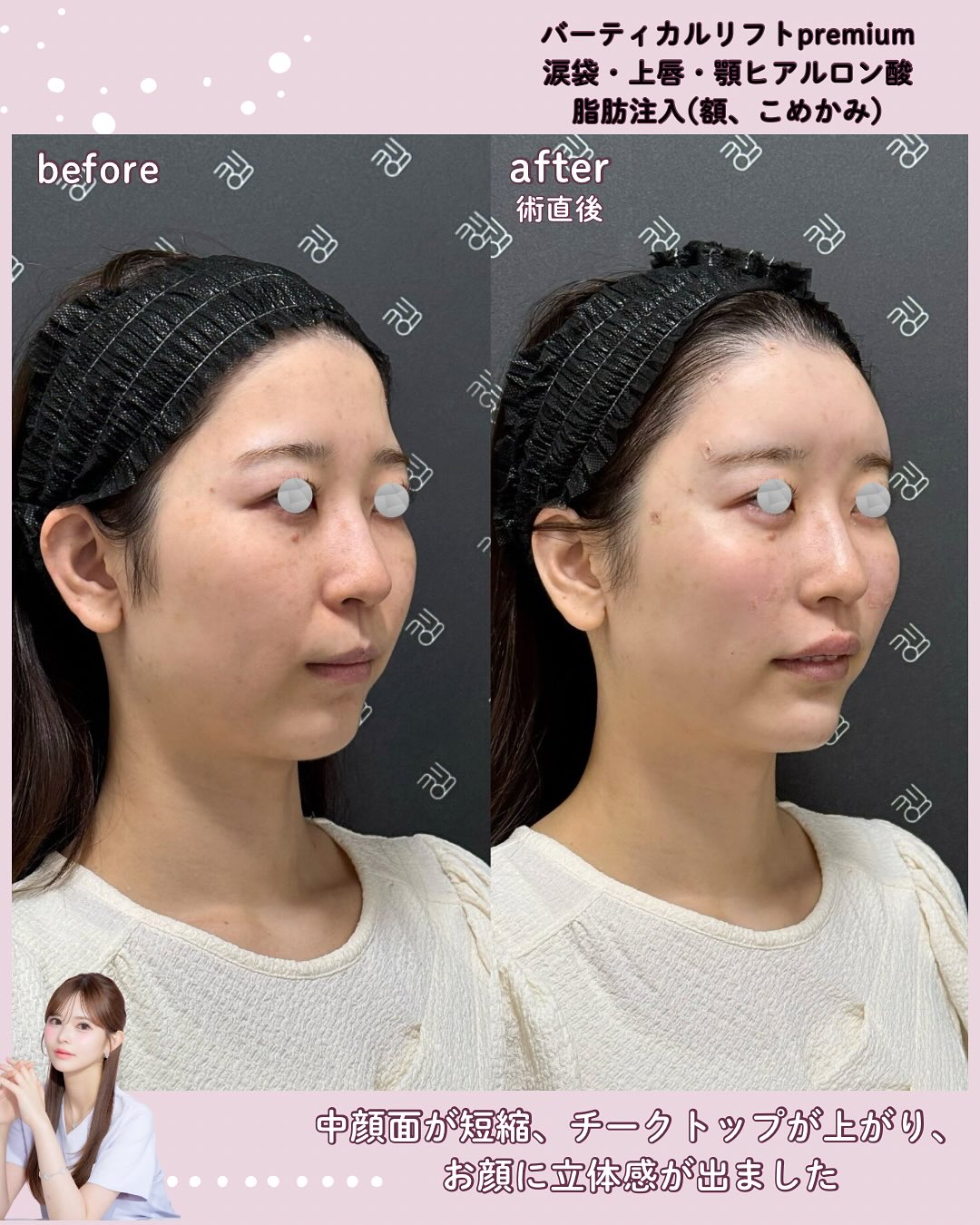 バーティカルリフトプレミアム×ドールヒアル