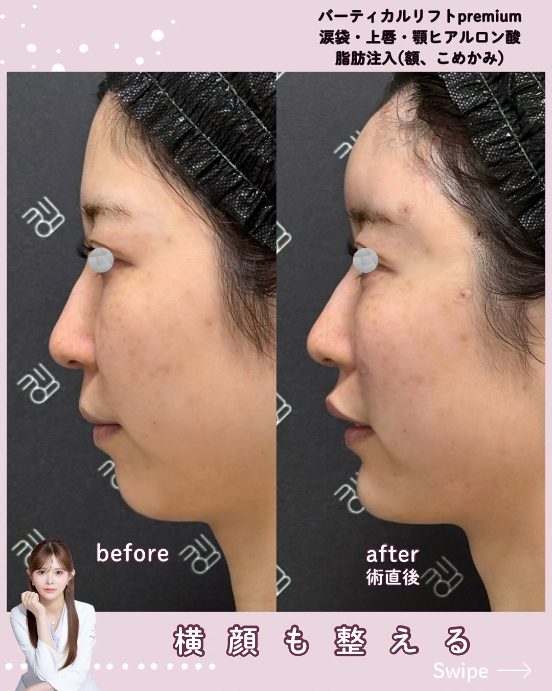 バーティカルリフトプレミアム×ドールヒアル