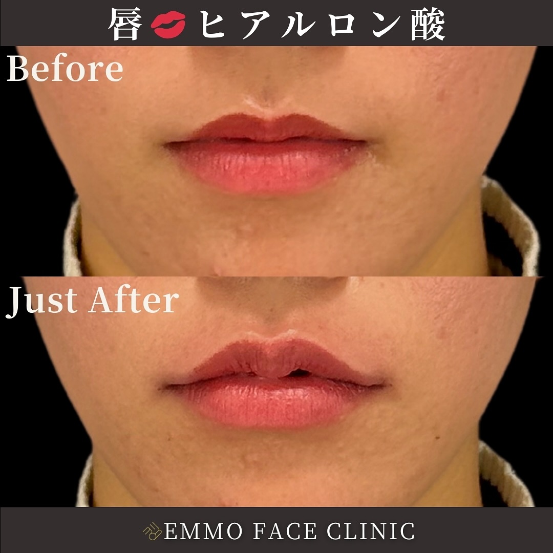 ヒアルロン酸(唇)