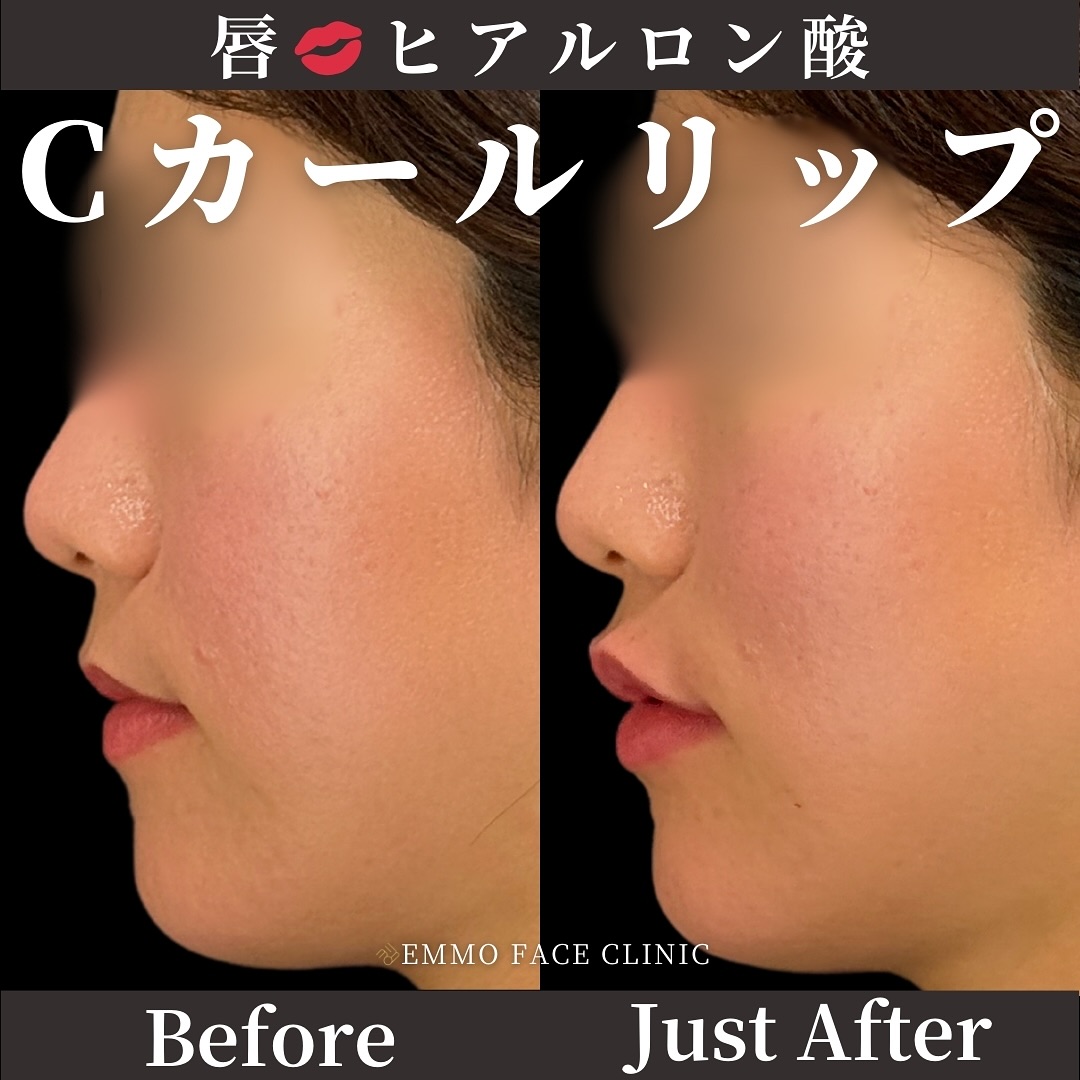 ヒアルロン酸(唇)